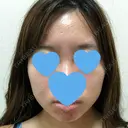 脂肪溶解注射（顔） UB CLINIC銀座 DAY 50 サムネイル用