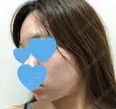 脂肪溶解注射（顔） UB CLINIC銀座 DAY 50 サムネイル用