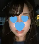 脂肪溶解注射（顔） UB CLINIC銀座 AFTER サムネイル用