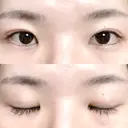 二重切開 松下皮フ形成外科 DAY 58 サムネイル用