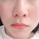 鼻尖形成（切開） / 小鼻縮小（切開） 湘南美容クリニック 神戸院 DAY 80 サムネイル用
