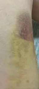 クマ治療 / 下まぶたの脂肪取り 湘南美容クリニック 赤羽院 DAY 7 サムネイル用