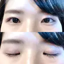 二重切開 松下皮フ形成外科 DAY 60 サムネイル用