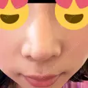 鼻尖形成（切開） / ヒアルロン酸注入（鼻） 東京ヒルズクリニック 岡崎院 DAY 7 サムネイル用