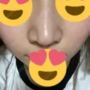 鼻尖形成（切開） / ヒアルロン酸注入（鼻） 東京ヒルズクリニック 岡崎院 DAY 8 サムネイル用