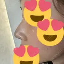 鼻尖形成（切開） / ヒアルロン酸注入（鼻） 東京ヒルズクリニック 岡崎院 DAY 8 サムネイル用