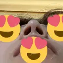 鼻尖形成（切開） / ヒアルロン酸注入（鼻） 東京ヒルズクリニック 岡崎院 DAY 8 サムネイル用