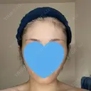 糸リフト / 脂肪吸引（顔） 銀座マイアミ美容外科 DAY 152 サムネイル用