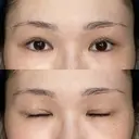 二重切開 / 目頭切開 / 眼瞼下垂（切開） / 上まぶたの脂肪取り 銀座マイアミ美容外科 DAY 153 サムネイル用