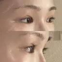 二重切開 / 目頭切開 / 眼瞼下垂（切開） / 上まぶたの脂肪取り 銀座マイアミ美容外科 DAY 153 サムネイル用