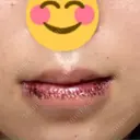 口唇縮小術 B-LINE CLINIC 池袋院 DAY 0 サムネイル用