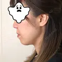 ハイフ（顔） 藤・ナチュレ美容クリニック 恵比寿院 DAY 7 サムネイル用