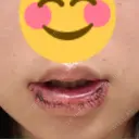 口唇縮小術 B-LINE CLINIC 池袋院 DAY 1 サムネイル用