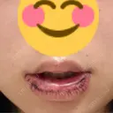 口唇縮小術 B-LINE CLINIC 池袋院 DAY 1 サムネイル用