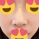 鼻尖形成（切開） / ヒアルロン酸注入（鼻） 東京ヒルズクリニック 岡崎院 AFTER サムネイル用