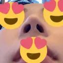 鼻尖形成（切開） / ヒアルロン酸注入（鼻） 東京ヒルズクリニック 岡崎院 DAY 9 サムネイル用