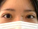 二重埋没 医療法人河田外科形成外科 AFTER サムネイル用