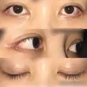 目尻切開 / 目尻靭帯移動 FROM B整形外科 (旧バウム整形外科) DAY 16 サムネイル用