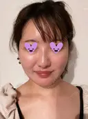 糸リフト / バッカルファット除去 / 脂肪吸引（顔） / メーラーファット除去 SEA CLINIC（シークリニック） DAY 31 サムネイル用