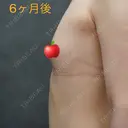 豊胸（脂肪注入） ヴェルトラクリニック 大阪院 DAY 212 サムネイル用