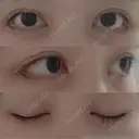 目尻切開 / 目尻靭帯移動 FROM B整形外科 (旧バウム整形外科) DAY 20 サムネイル用