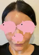 脂肪吸引（顔） / 切開リフト / ヒアルロン酸注入（ほうれい線） 東京エビスクリニック DAY 211 サムネイル用