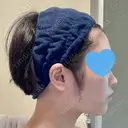 糸リフト / 脂肪吸引（顔） 銀座マイアミ美容外科 DAY 181 サムネイル用