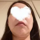 糸リフト 湘南美容クリニック 岡山院 DAY 8 サムネイル用