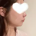 糸リフト 湘南美容クリニック 岡山院 DAY 8 サムネイル用