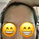こめかみ形成 SSクリニック AFTER サムネイル用