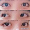 目尻切開 / 目尻靭帯移動 FROM B整形外科 (旧バウム整形外科) DAY 24 サムネイル用