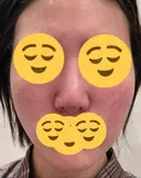 ほくろ・いぼ切除（肌） / その他（肌） / 美肌レーザー / シミ取りレーザー / 美白レーザー クロスクリニック銀座 DAY 41 サムネイル用