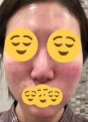 ほくろ・いぼ切除（肌） / その他（肌） / 美肌レーザー / シミ取りレーザー / 美白レーザー クロスクリニック銀座 DAY 41 サムネイル用