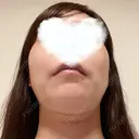 糸リフト 湘南美容クリニック 岡山院 DAY 10 サムネイル用