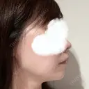 糸リフト 湘南美容クリニック 岡山院 DAY 10 サムネイル用