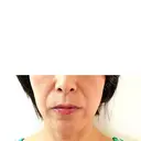 プラセンタ注射 / ハイフ（顔） 心斎橋藤井クリニック AFTER サムネイル用