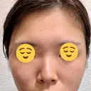 軟骨移植 フェアクリニック川口 DAY 44 サムネイル用