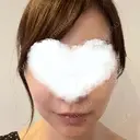 糸リフト 湘南美容クリニック 岡山院 AFTER サムネイル用