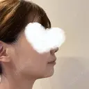 糸リフト 湘南美容クリニック 岡山院 DAY 12 サムネイル用