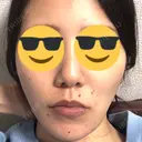 骨切り（あご） / 脂肪吸引（顔） 銀座マイアミ美容外科 DAY 111 サムネイル用