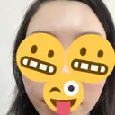 脂肪注入（額） 牧野美容クリニック DAY 25 サムネイル用