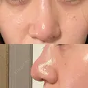 鼻尖形成（切開） / 鼻尖縮小 / その他（鼻） 聖心美容クリニック 札幌院 DAY 10 サムネイル用