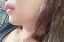 あごプロテーゼ 北尾クリニック AFTER サムネイル用