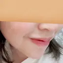 あごプロテーゼ 北尾クリニック DAY 91 サムネイル用