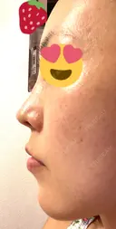 鼻尖形成（切開） / 鼻中隔延長（切開） / 軟骨移植 / ワシ鼻修正・ハンプ切除 / 真皮移植 湘南美容クリニック 上野院 DAY 235 サムネイル用