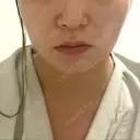 糸リフト 表参道スキンクリニック 表参道院 AFTER サムネイル用