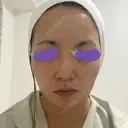 脂肪吸引（顔） 表参道スキンクリニック 表参道院 AFTER サムネイル用