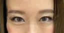 クマ治療 / 下まぶたたるみ取り / 下まぶたの脂肪取り セオリークリニック DAY 155 サムネイル用