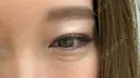 クマ治療 / 下まぶたたるみ取り / 下まぶたの脂肪取り セオリークリニック DAY 155 サムネイル用