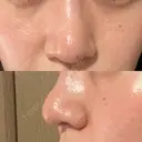 鼻尖形成（切開） / 鼻尖縮小 / その他（鼻） 聖心美容クリニック 札幌院 DAY 11 サムネイル用